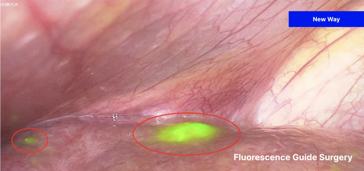 S-uncertainities-img-02-Fluorescence Guide Surgery(new way)